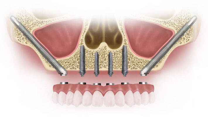 Implant Zygoma