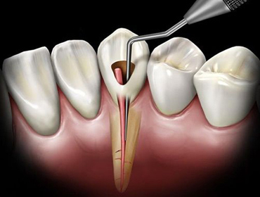 Điều trị tủy răng lại