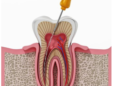 Điều trị tuỷ răng