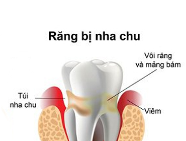 Viêm quanh răng