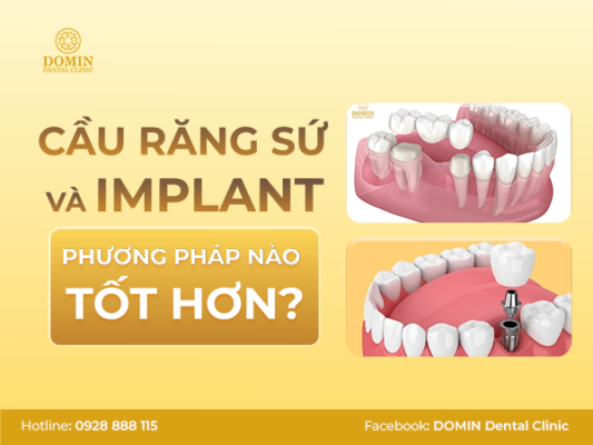 Cầu răng sứ và implant