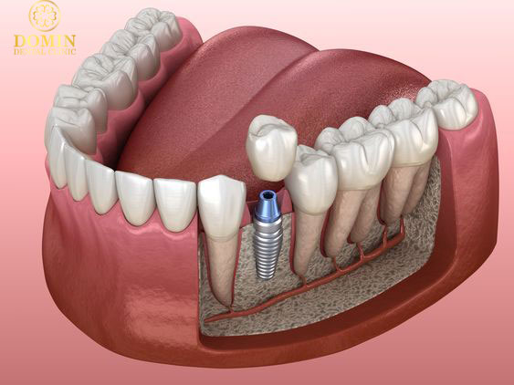 Trồng răng implant