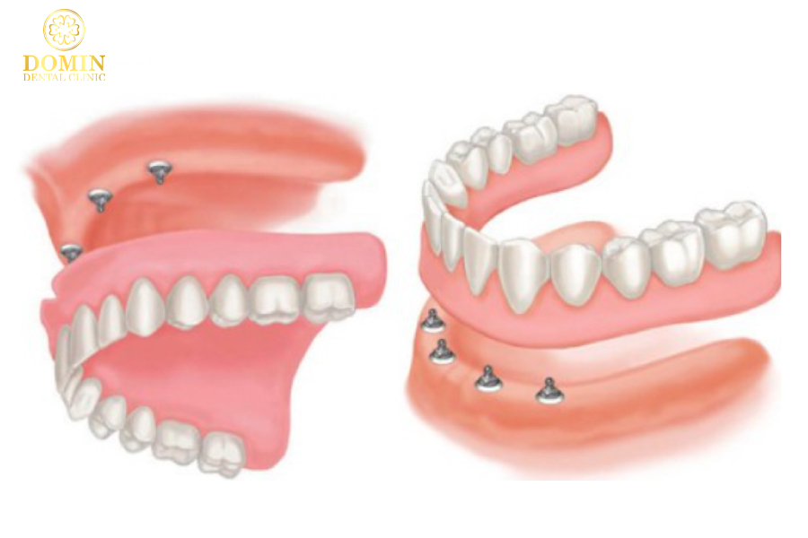 hàm tháo lắp trên implant