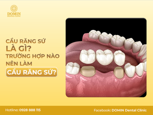 Trồng răng sứ bắc cầu