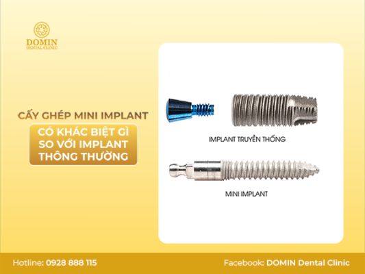 cấy ghép mini implant