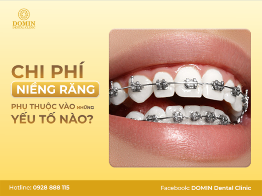 Chi phí niềng răng phụ thuộc