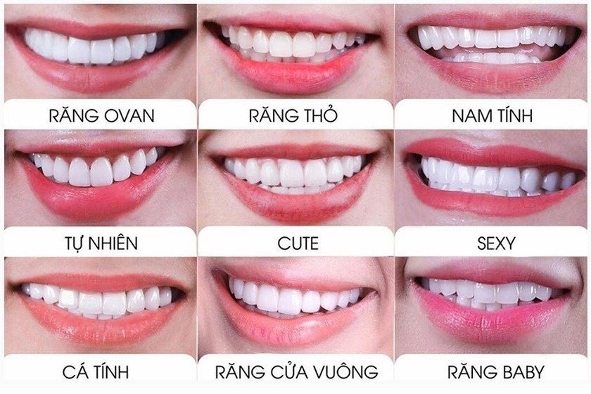 Dáng răng sứ đang được ưa chuộng