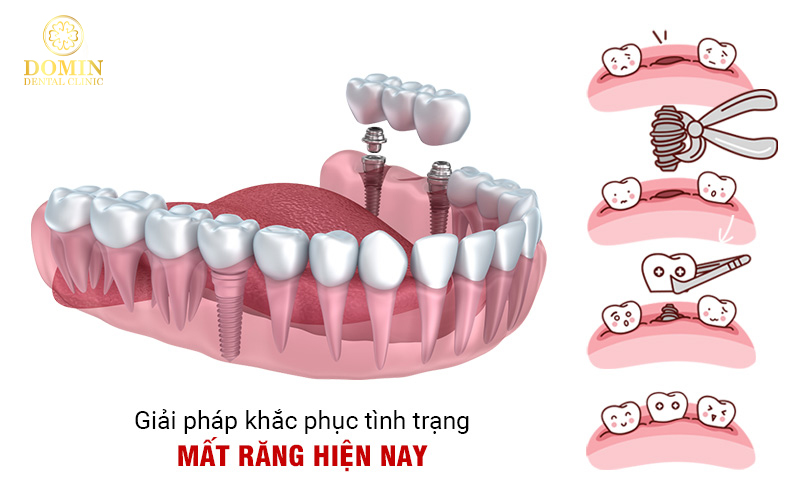 Cầu răng sứ và implant