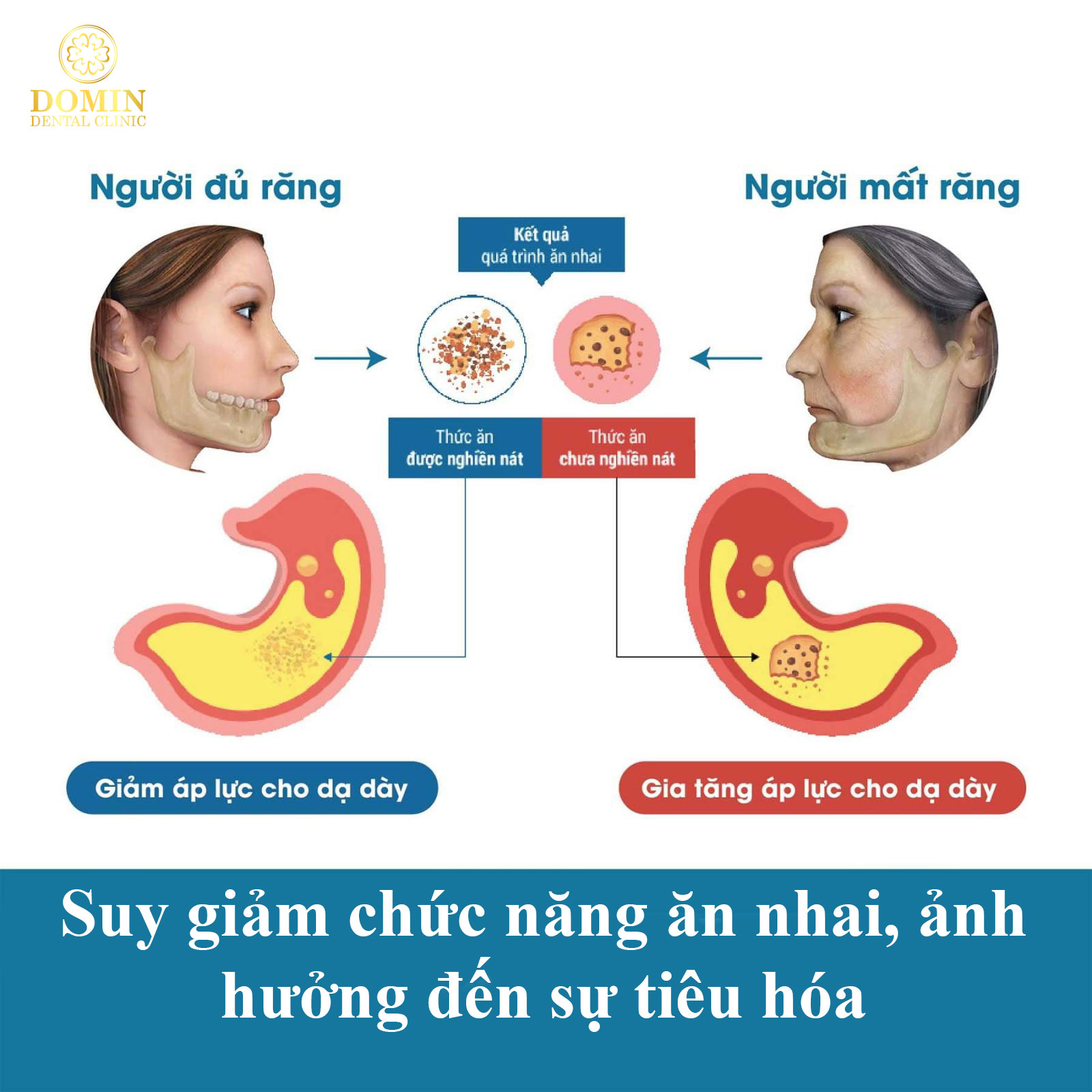 trồng implant quá muộn