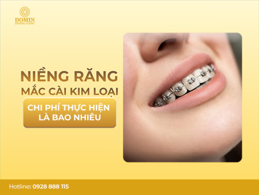 niềng răng mắc cài kim loại