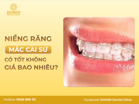 niềng răng mắc cài sứ