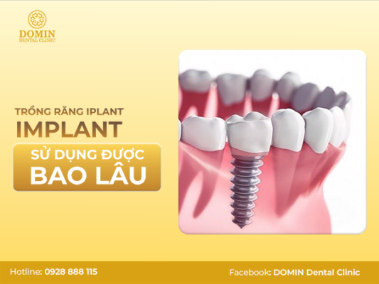 răng implant