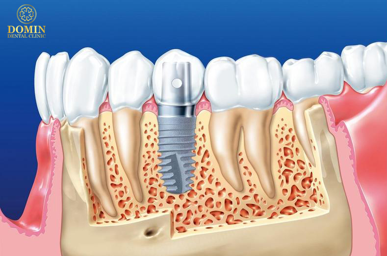 răng implant