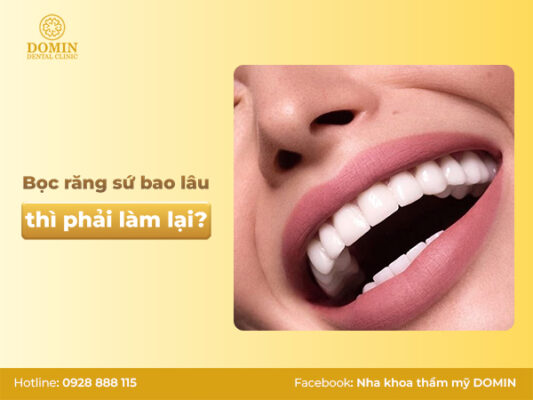 Bọc răng sứ bao lâu thì phải làm lại