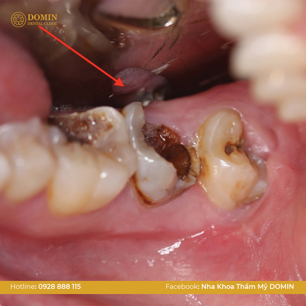 Răng bị sâu, viêm nha chu, nhiễm trùng nặng - Những trường hợp không nên bọc răng sứ 