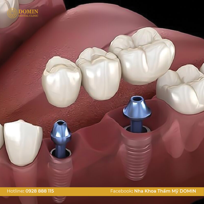 Cầu răng được hỗ trợ bằng implant - Các loại cầu răng sứ phổ biến