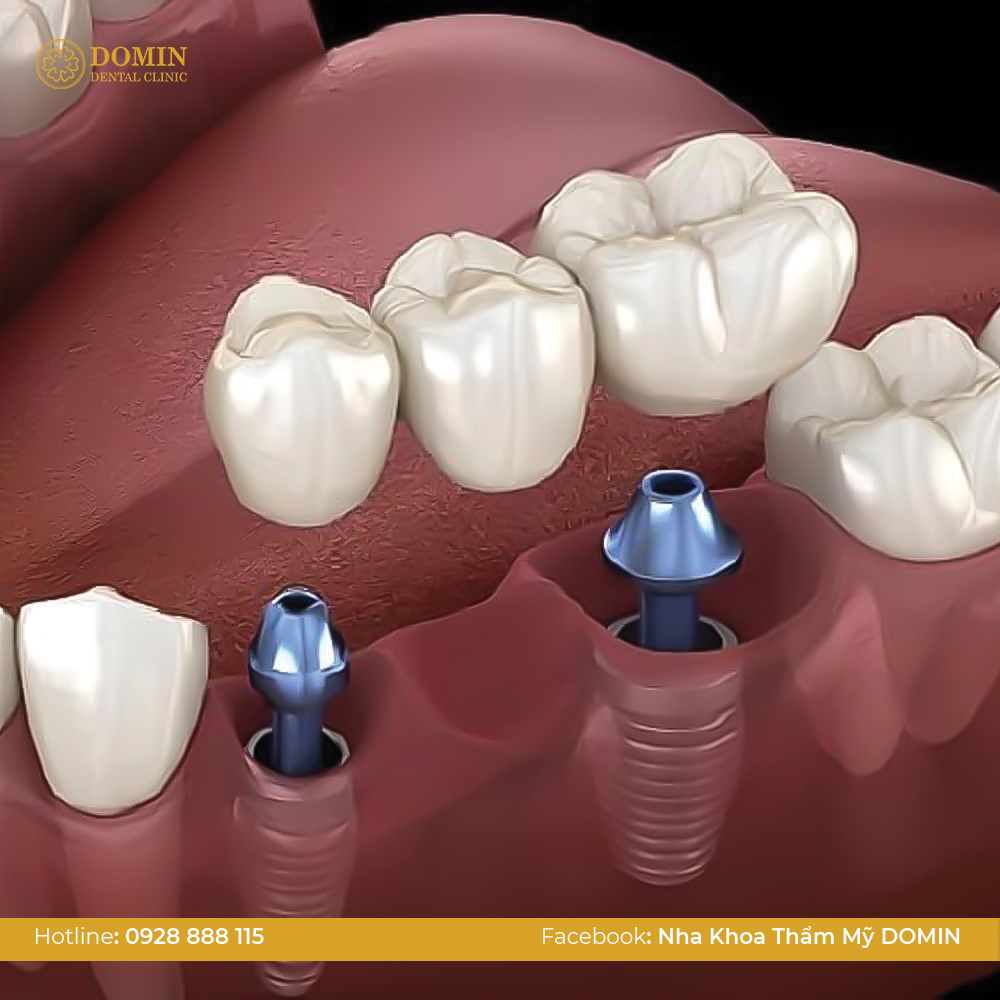 Cầu răng sứ trên Implant