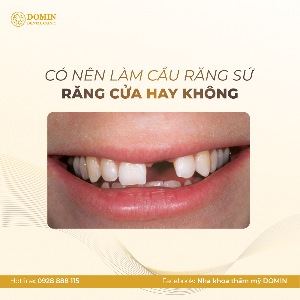 Có nên làm cầu răng sứ răng cửa hay không?