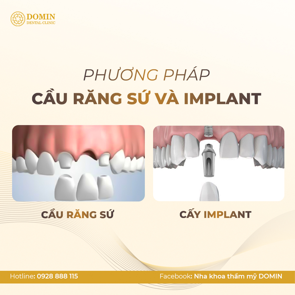 Nếu mất răng cửa thì nên làm cầu răng sứ hay làm răng Implant.