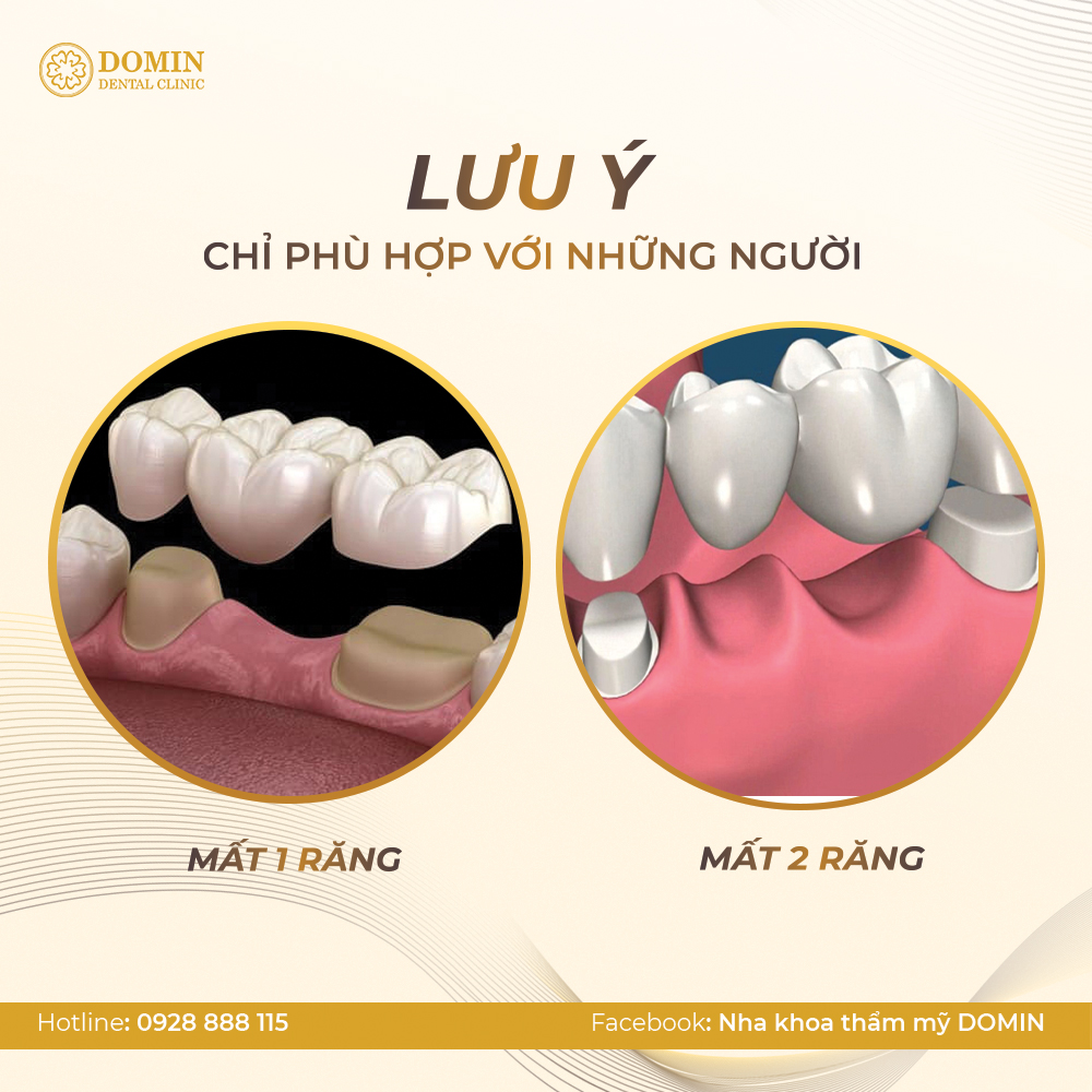 Răng cầu sứ chỉ phù hợp với trường hợp mất 1 đến 2 răng