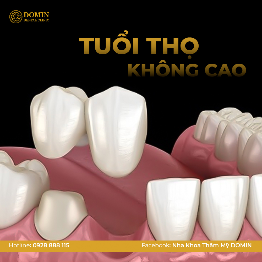 Cầu răng sứ có tuổi thọ sử dụng không cao