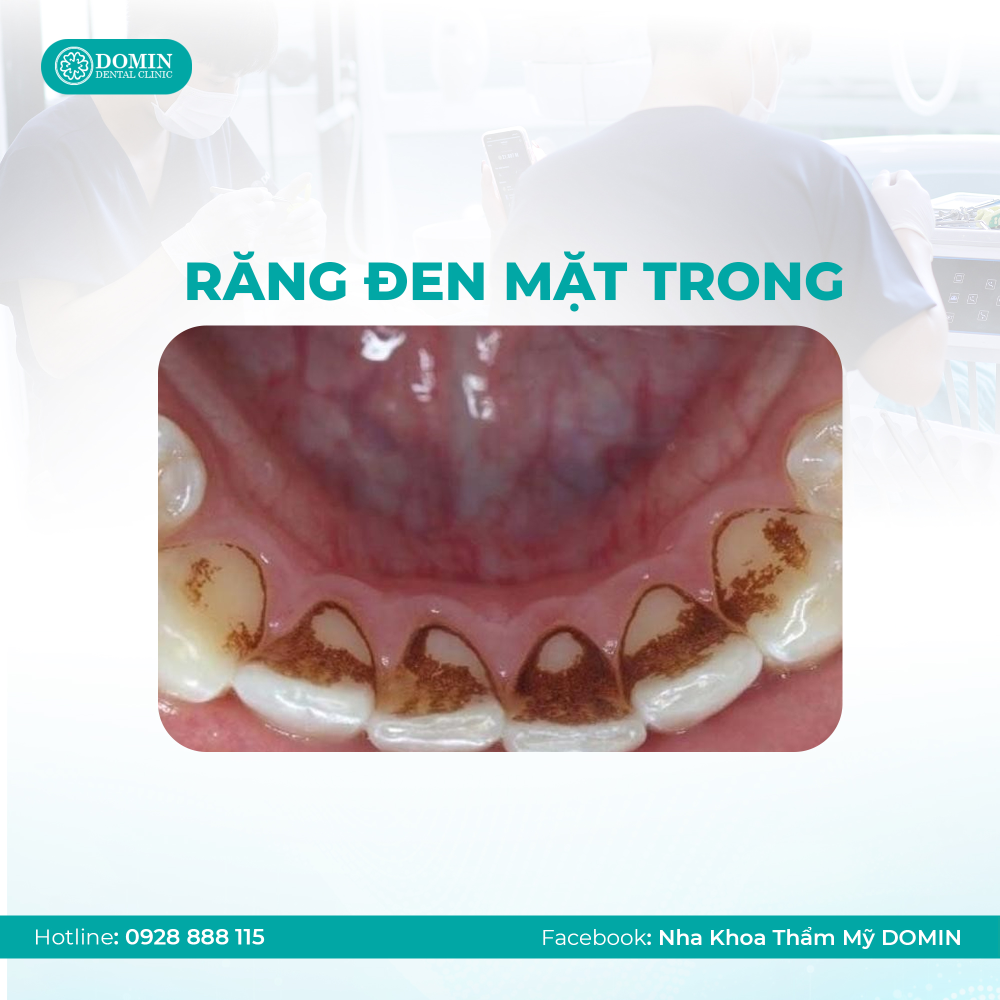 Răng bị đen mặt trong có ảnh hưởng gì không?