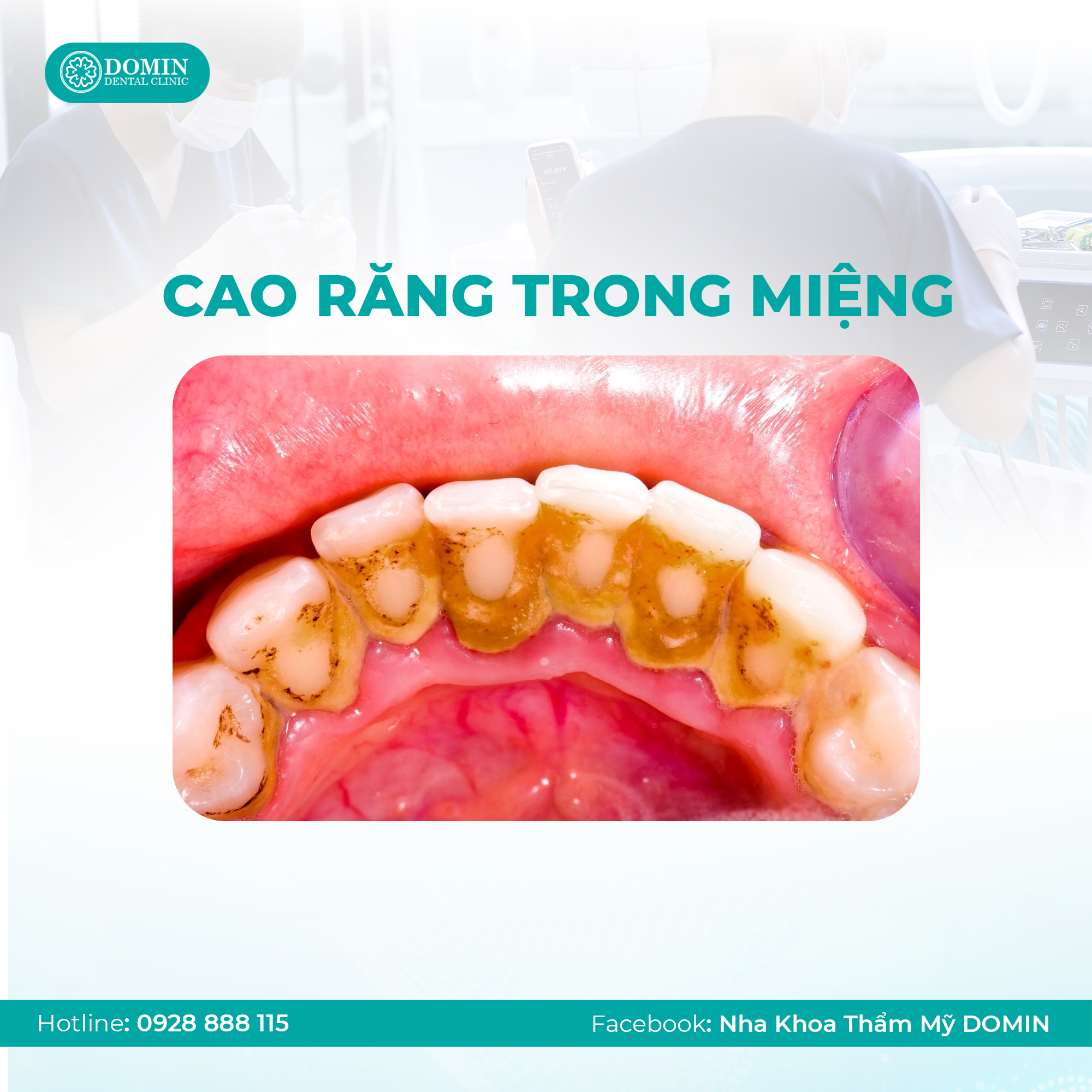 Răng bị đen mặt trong có ảnh hưởng gì không?