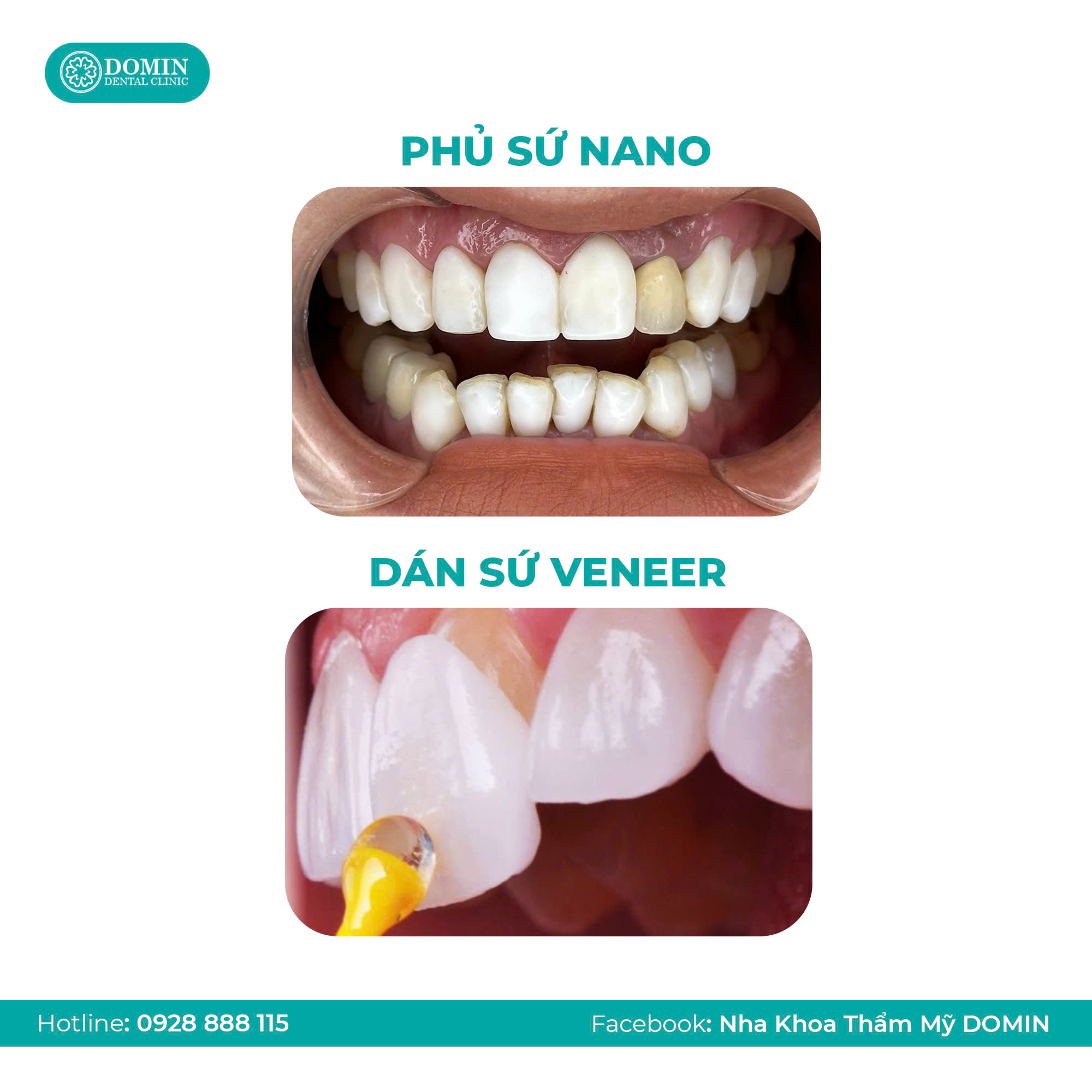 Phân biệt phủ sứ Nano và dán sứ Veneer 