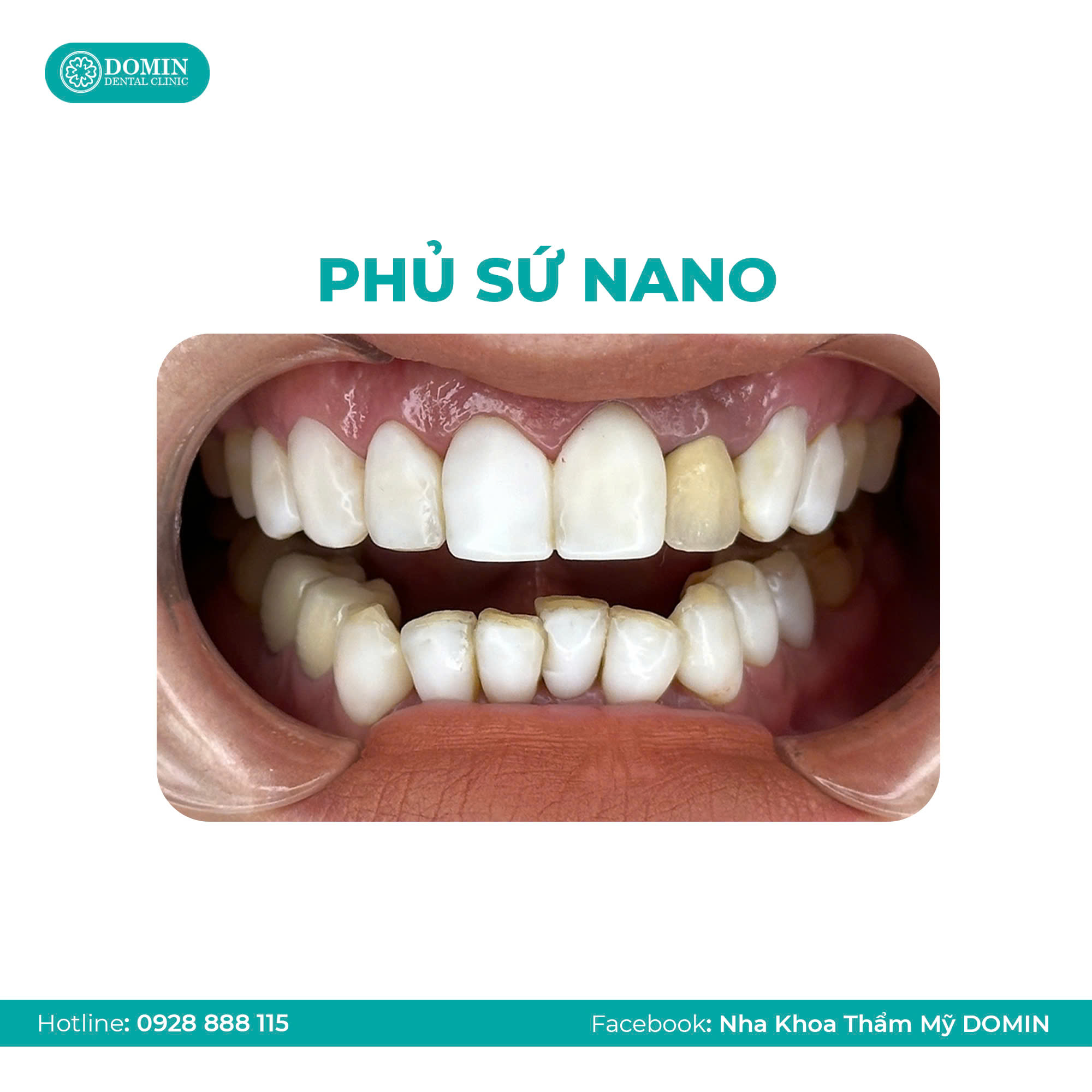 Phân biệt phủ sứ Nano và dán sứ Veneer 