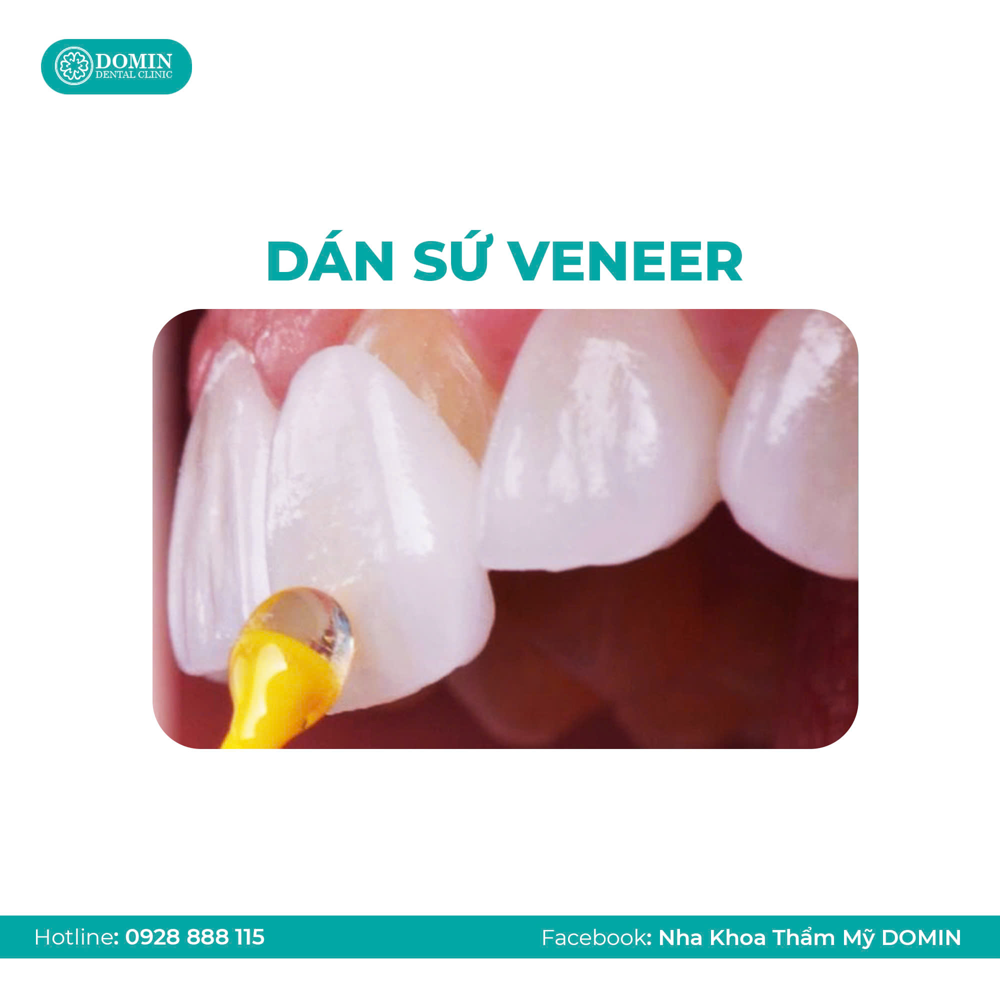 Phân biệt phủ sứ Nano và dán sứ Veneer 