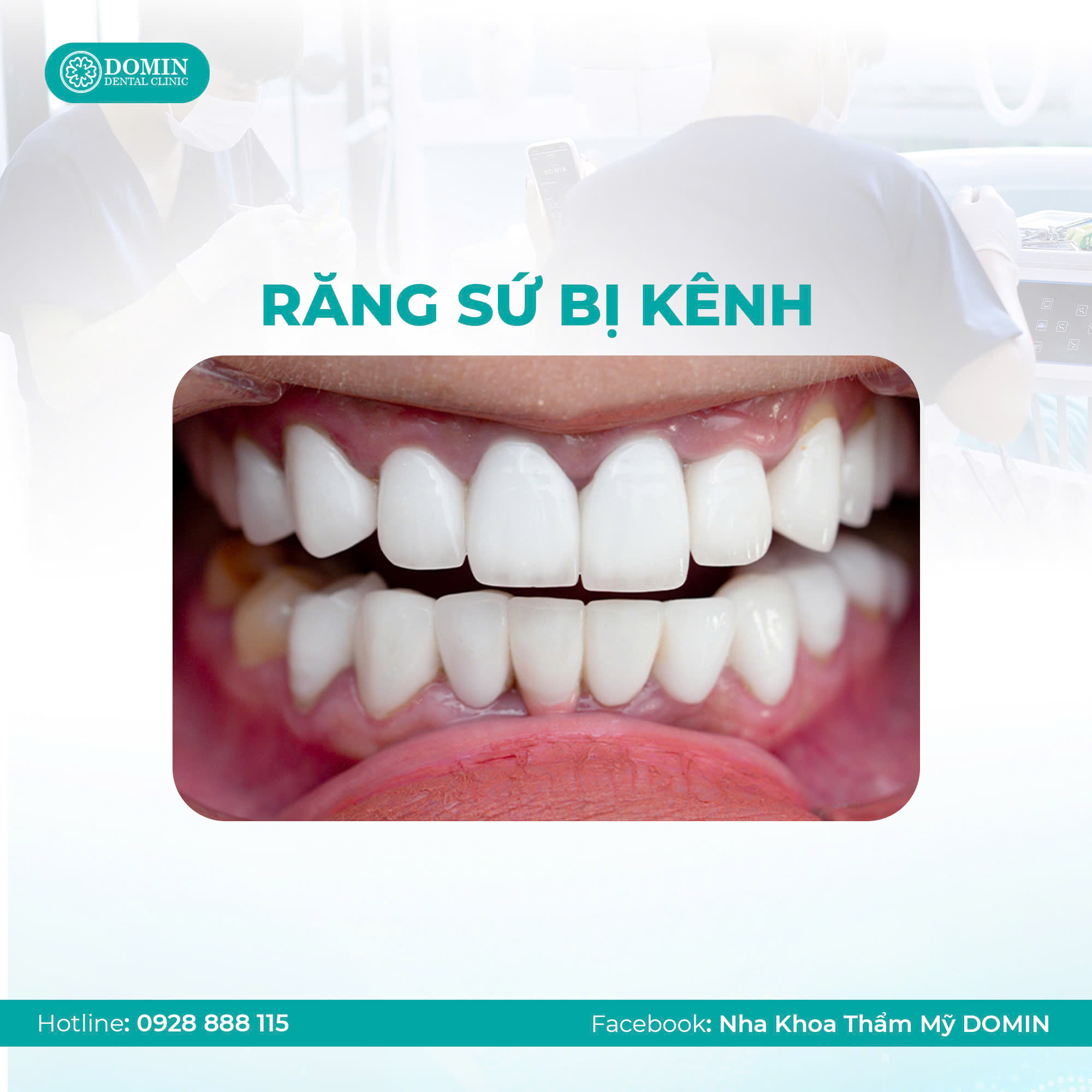 Răng sứ bị kênh có ảnh hưởng gì không?