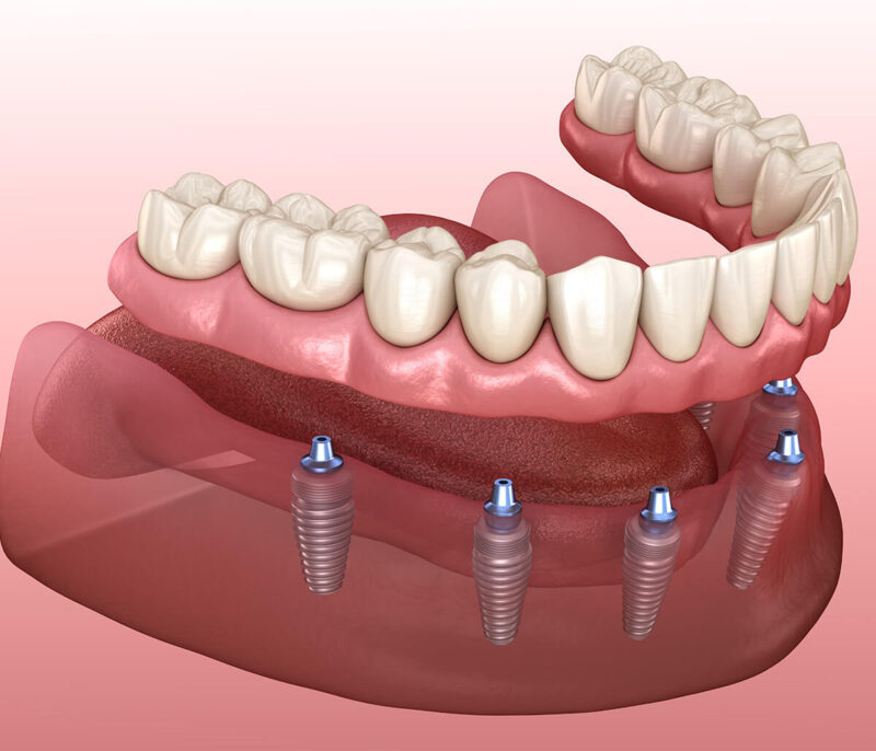 Hàm Tháo Lắp Trên Implant 