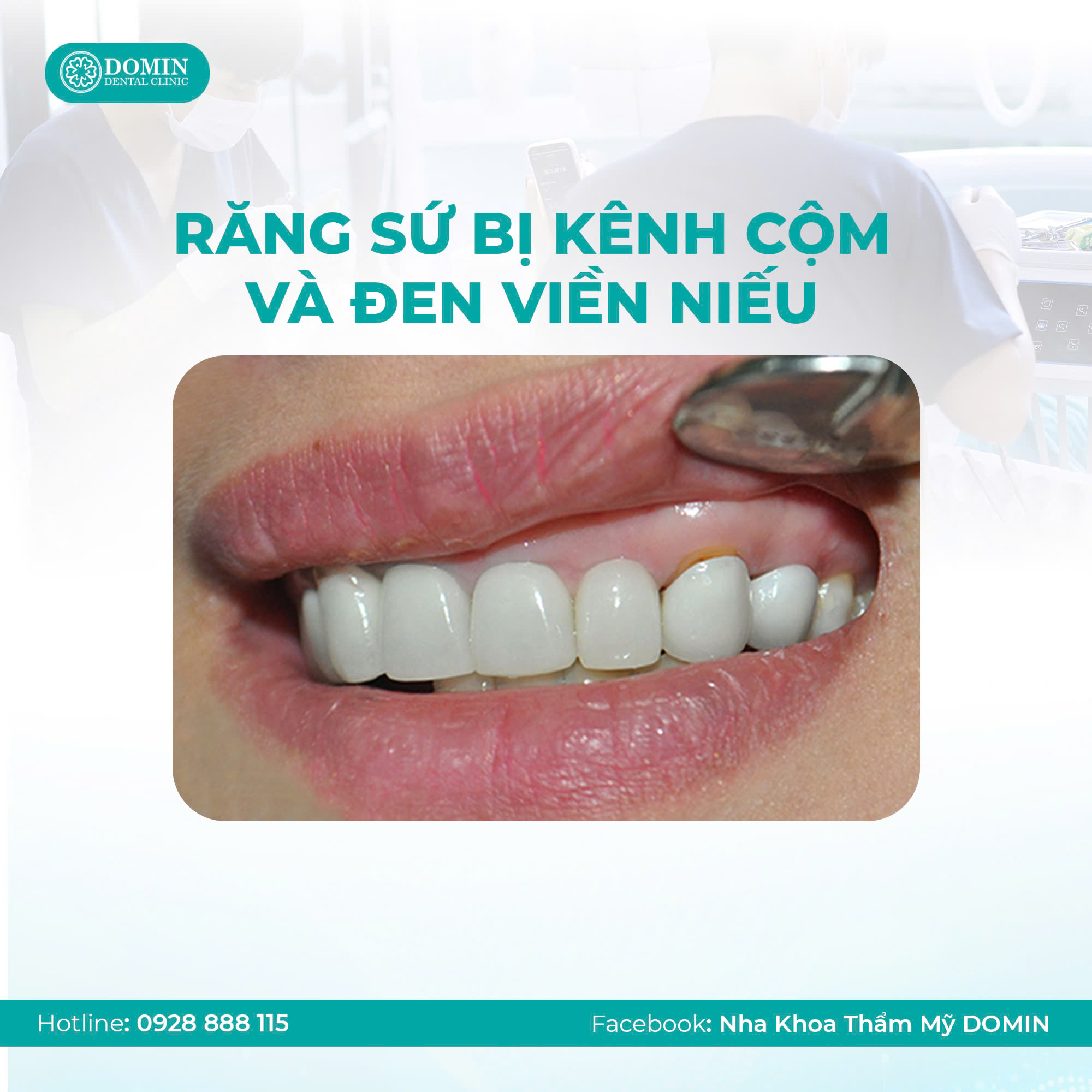 Bọc răng sứ lần 2 được thực hiện như thế nào?