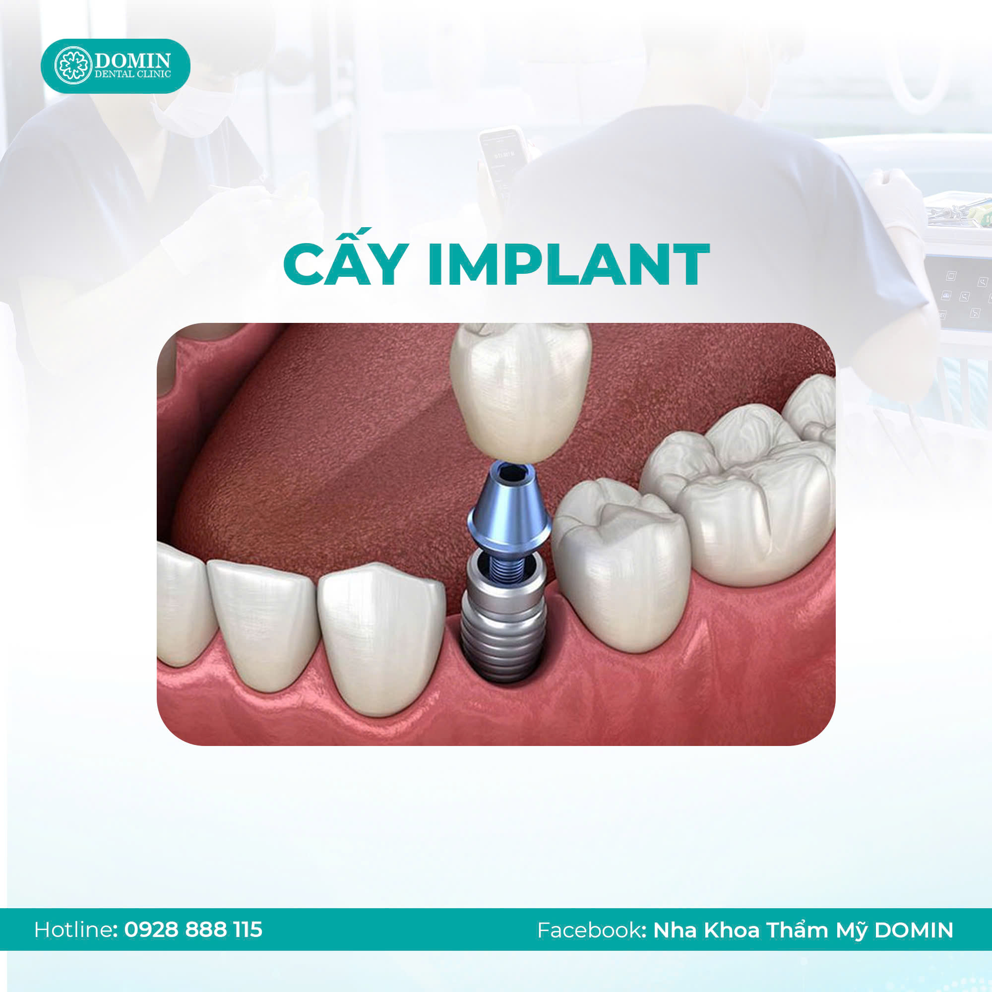 Sau khi trồng răng Implant có niềng răng được không?