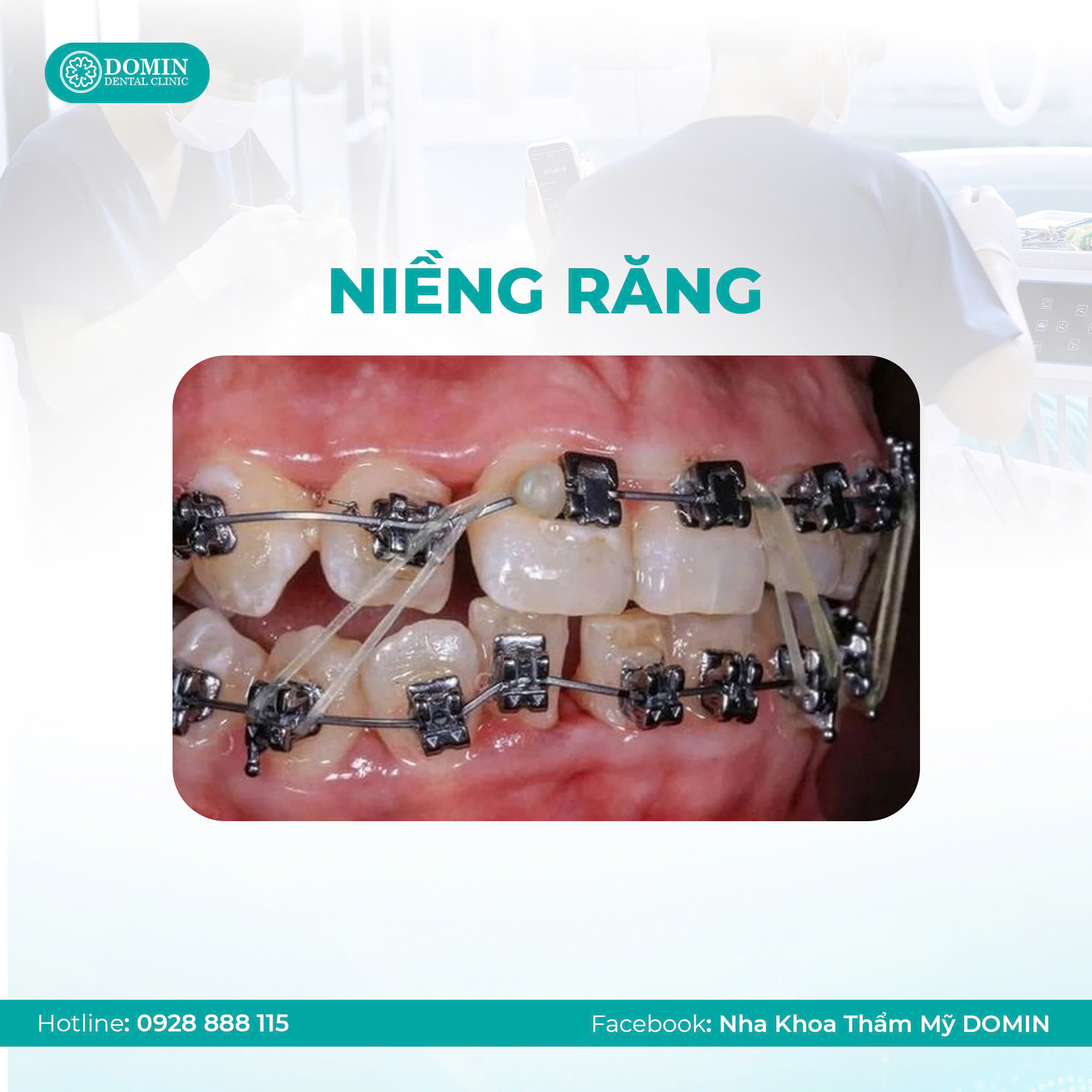 Sau khi trồng răng Implant có niềng răng được không?