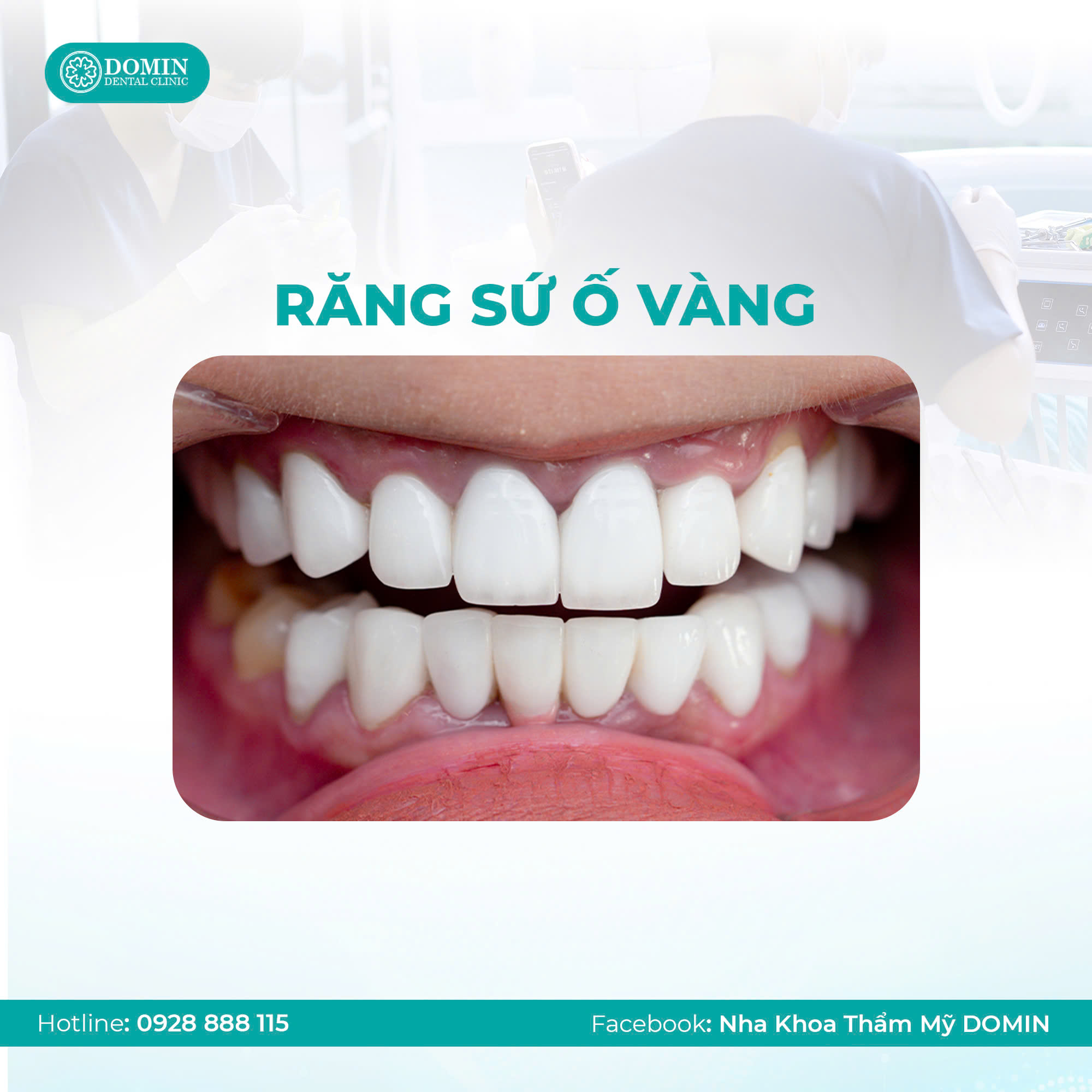 Bọc răng sứ rồi có tẩy trắng được không?