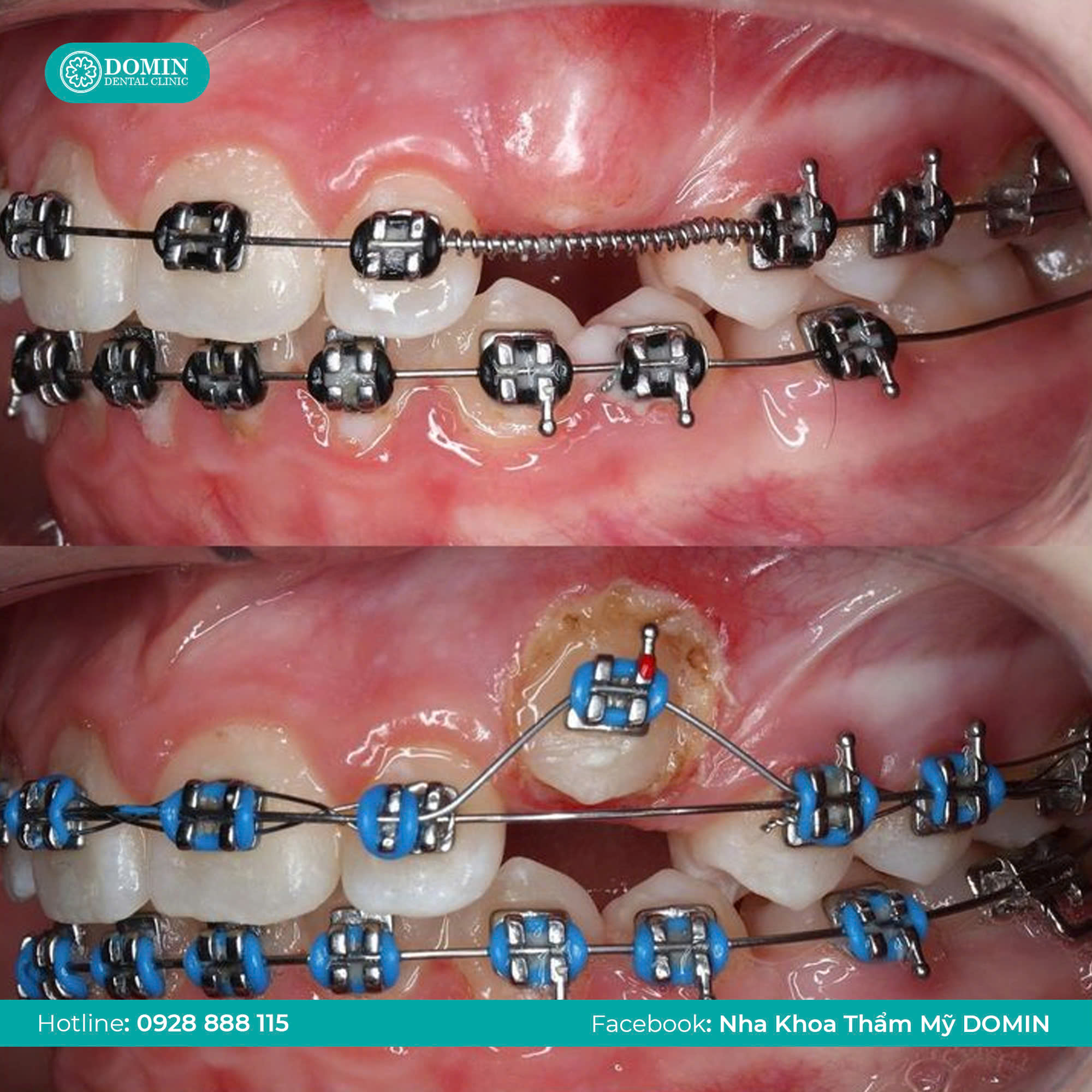 Niềng răng bị tiêu xương phải làm sao?