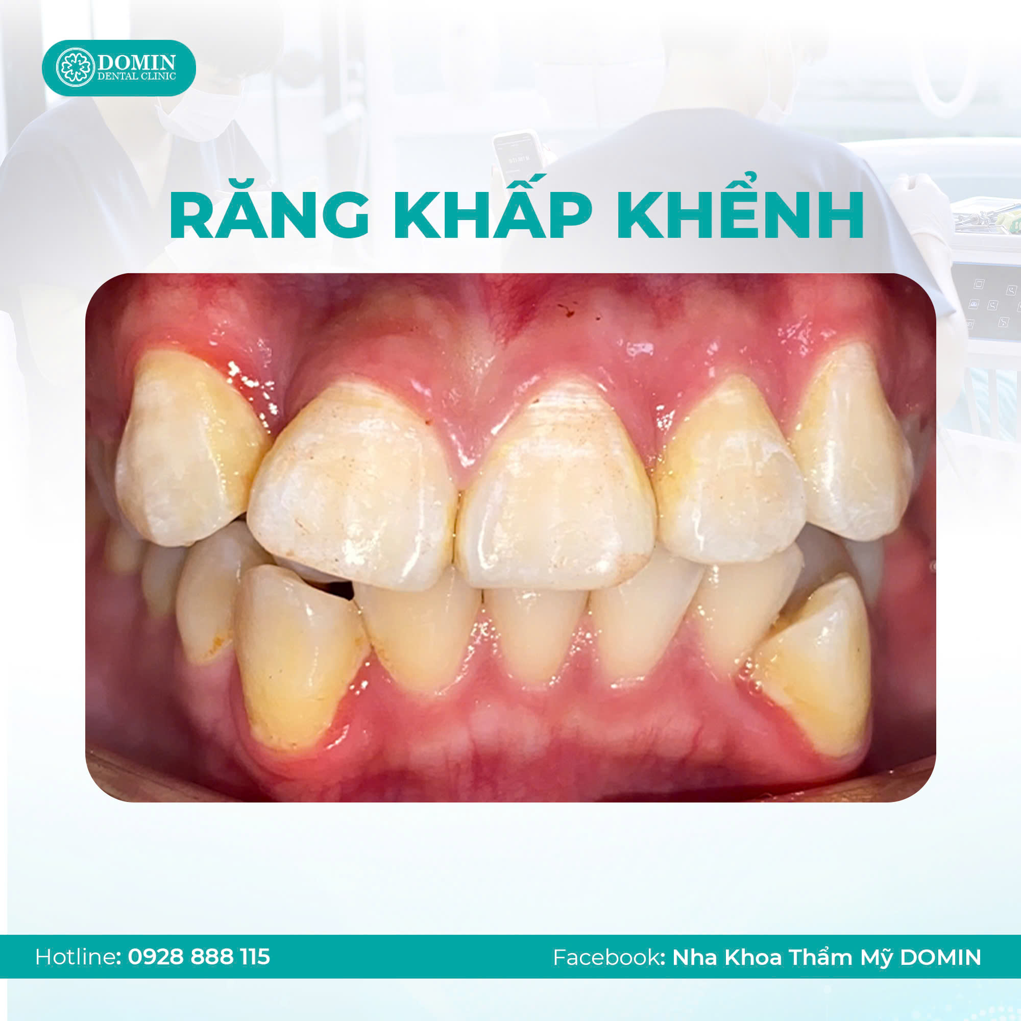 Niềng răng khấp khểnh có lâu không?