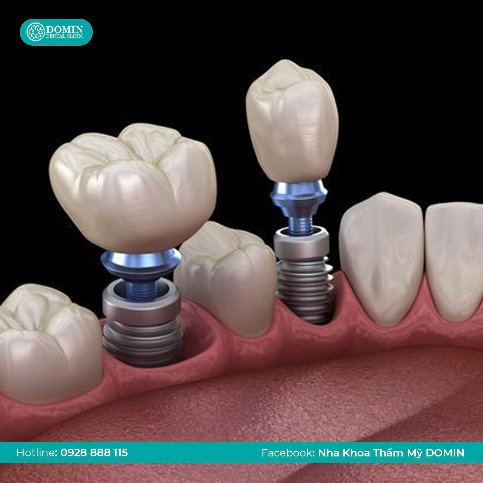 Mới nhổ răng xong trồng Implant được không?