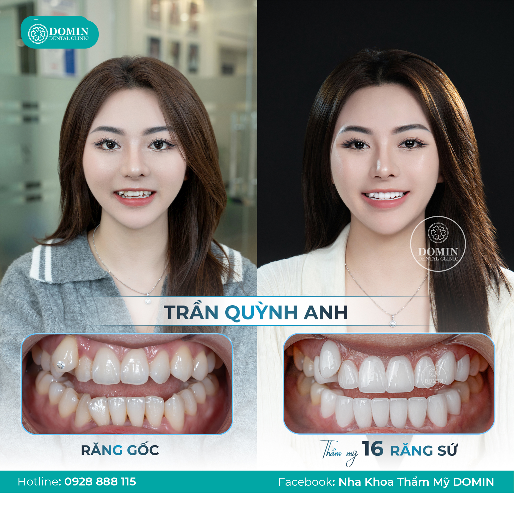 Hình ảnh khách hàng trước và sau khi bọc sứ 