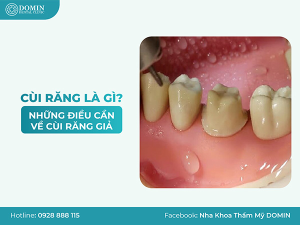 Cui Rangw Cùi răng là gì? Những điều cần biết về cùi răng giả - Nha Khoa Thẩm Mỹ ...