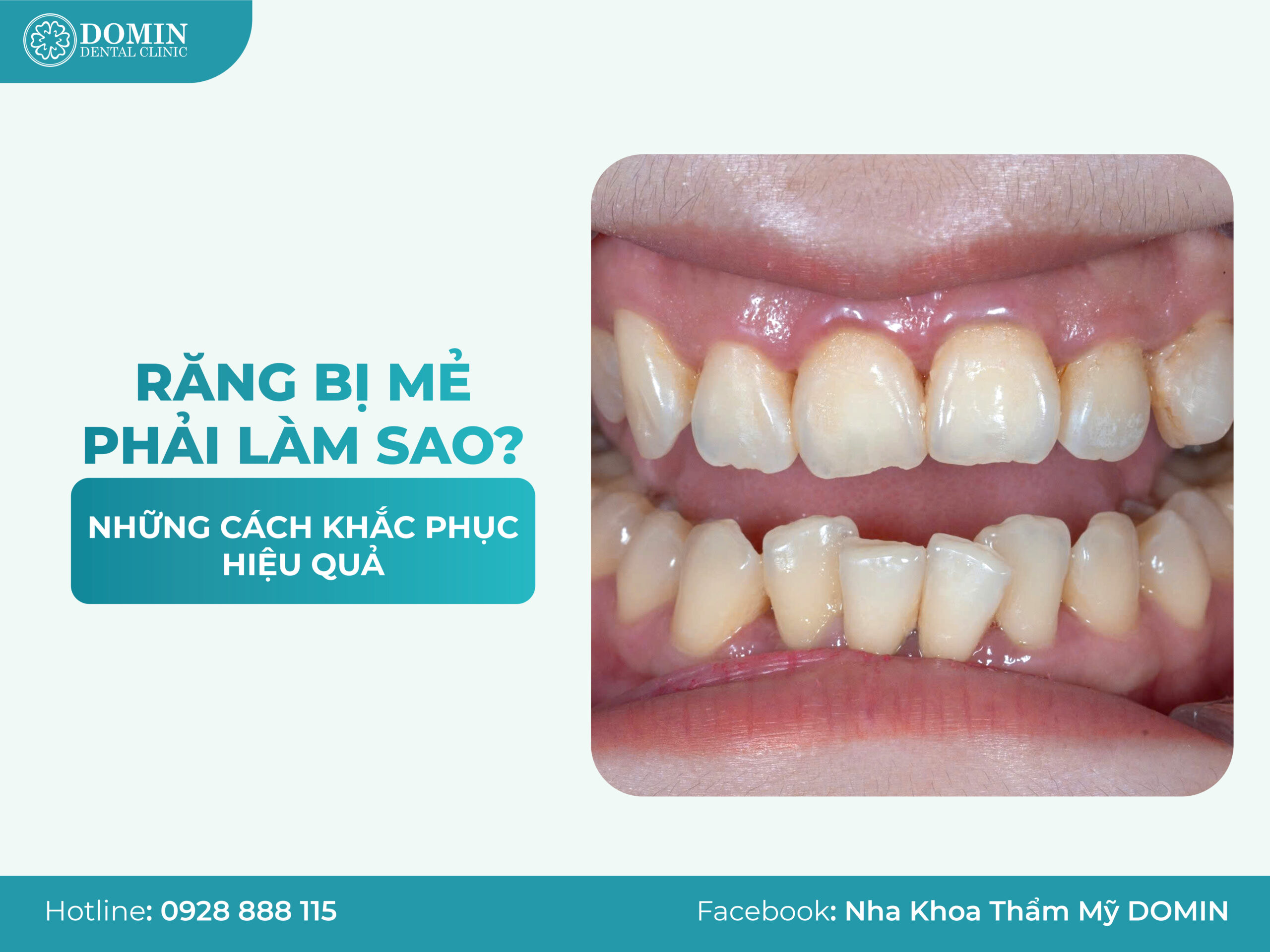 Răng bị mẻ phải làm sao? Những cách khắc phục hiệu quả - Nha Khoa Thẩm ...