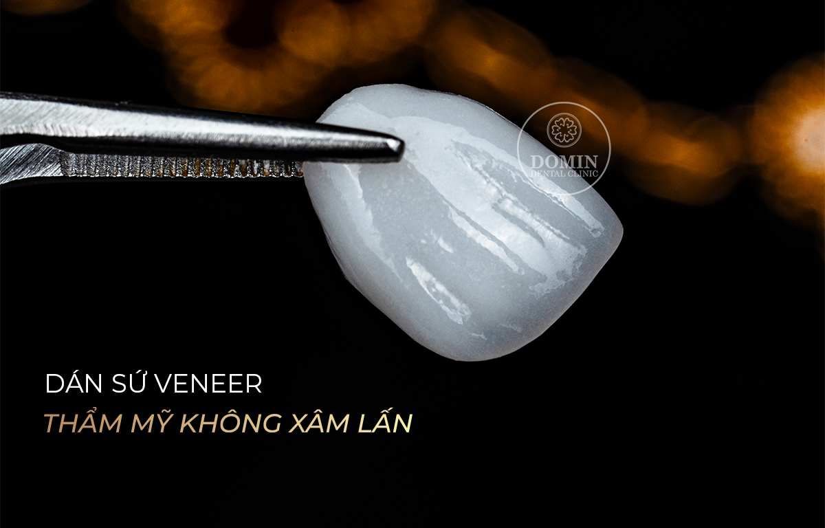 Chất lượng mặt dán sứ quyết định giá thành