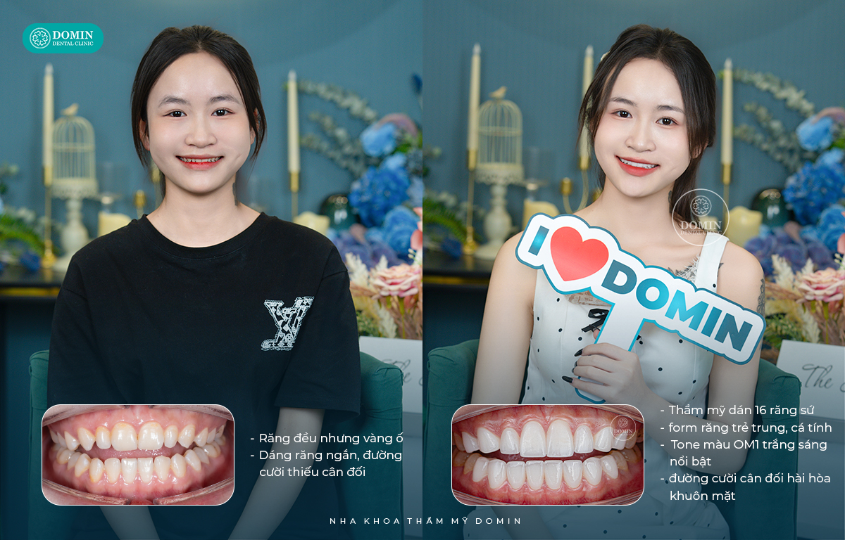 Hình ảnh trước -sau khách hàng dán sứ