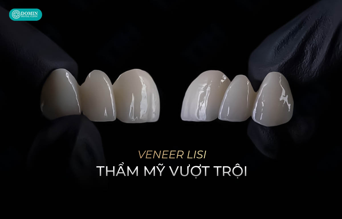 Veneer Lisi đảm bảo thẩm mỹ vượt trội