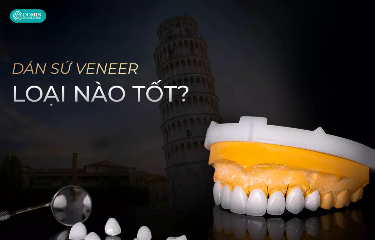 Dán sứ veneer loại nào tốt nhất hiện nay.