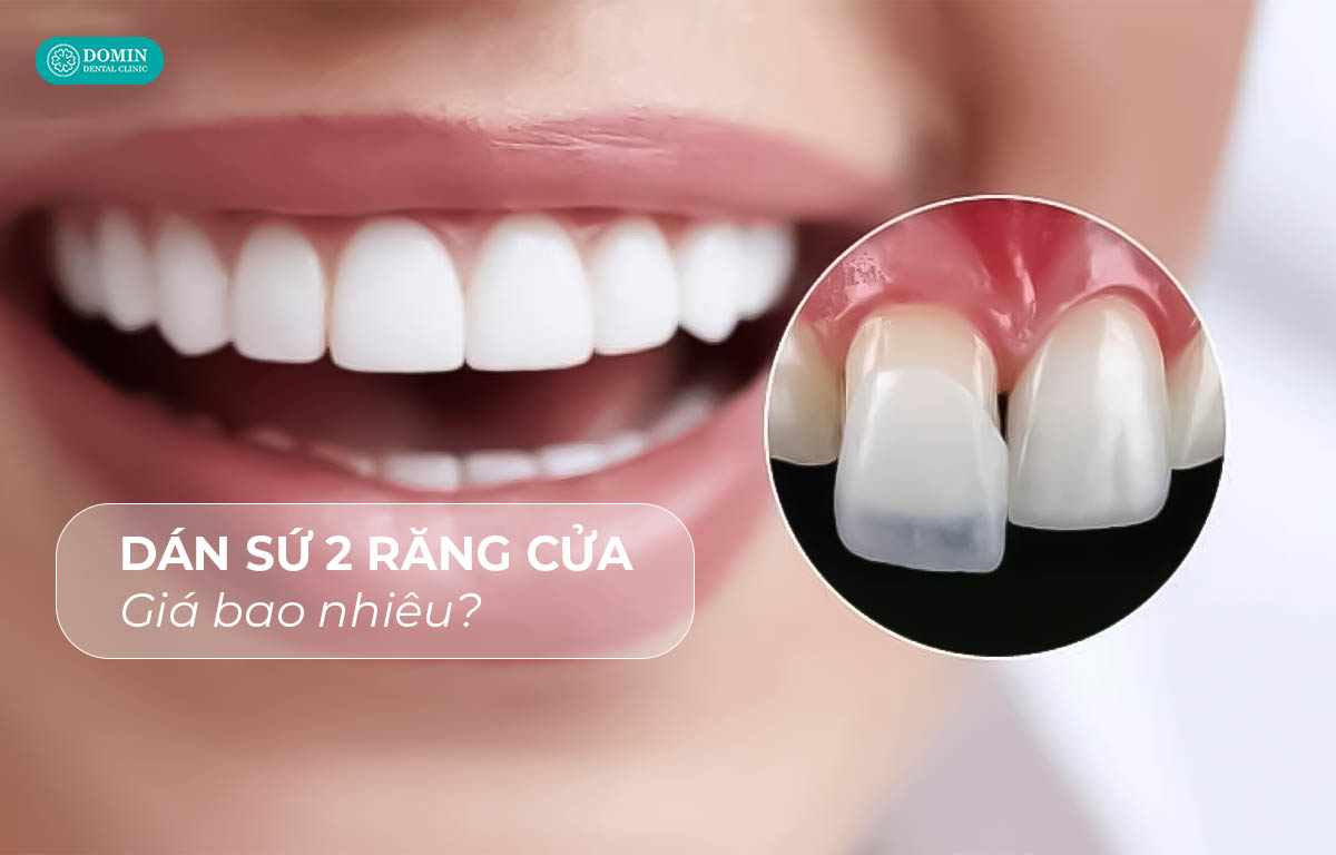 Dán sứ veneer 2 răng cửa giá bao nhiêu?