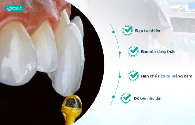 Dán sứ veneer mang đến nhiều ưu điểm