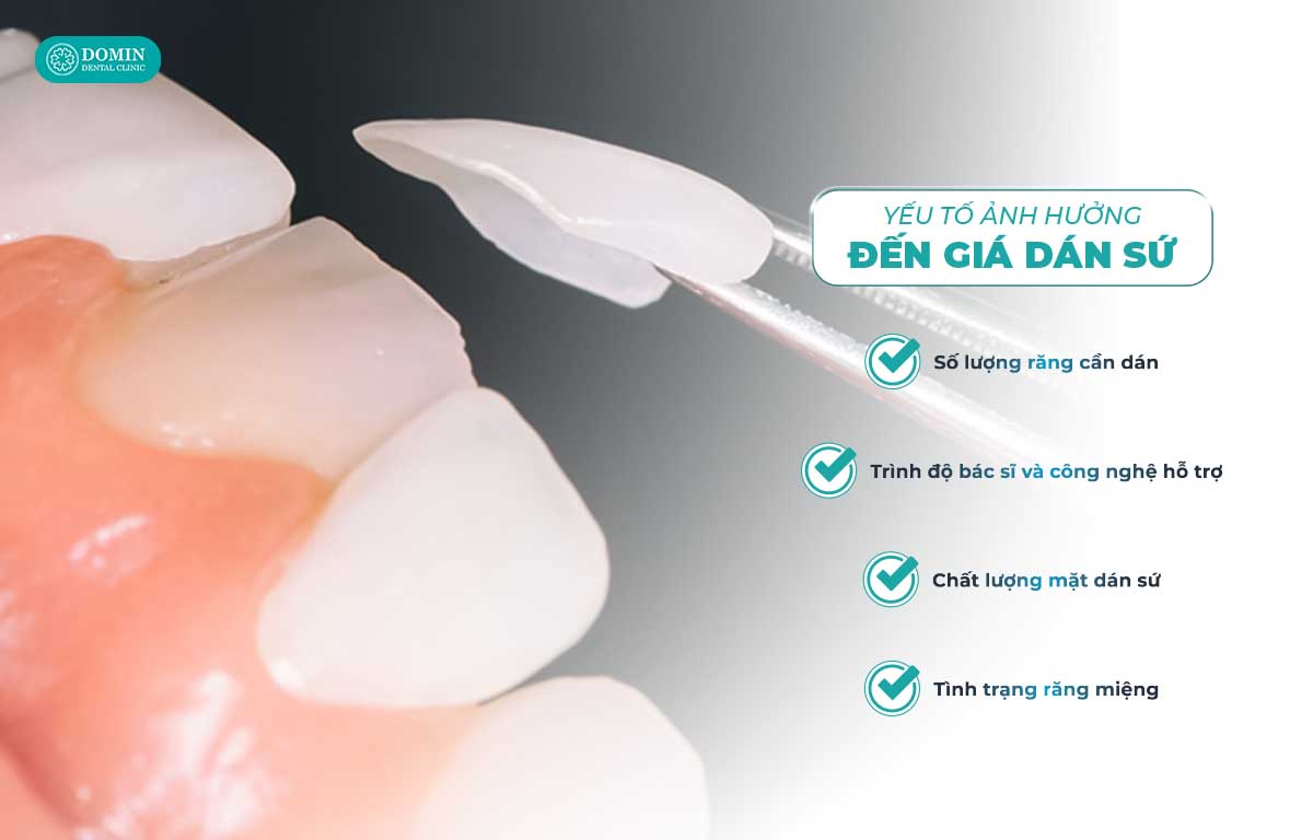 Các yếu tố ảnh hưởng đến giá dán sứ veneer