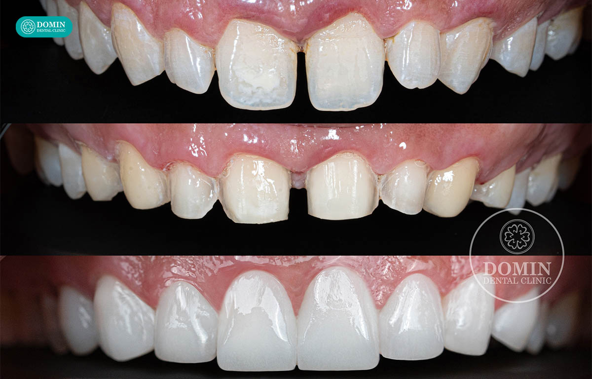Dán sứ veneer khi răng có khe thưa.